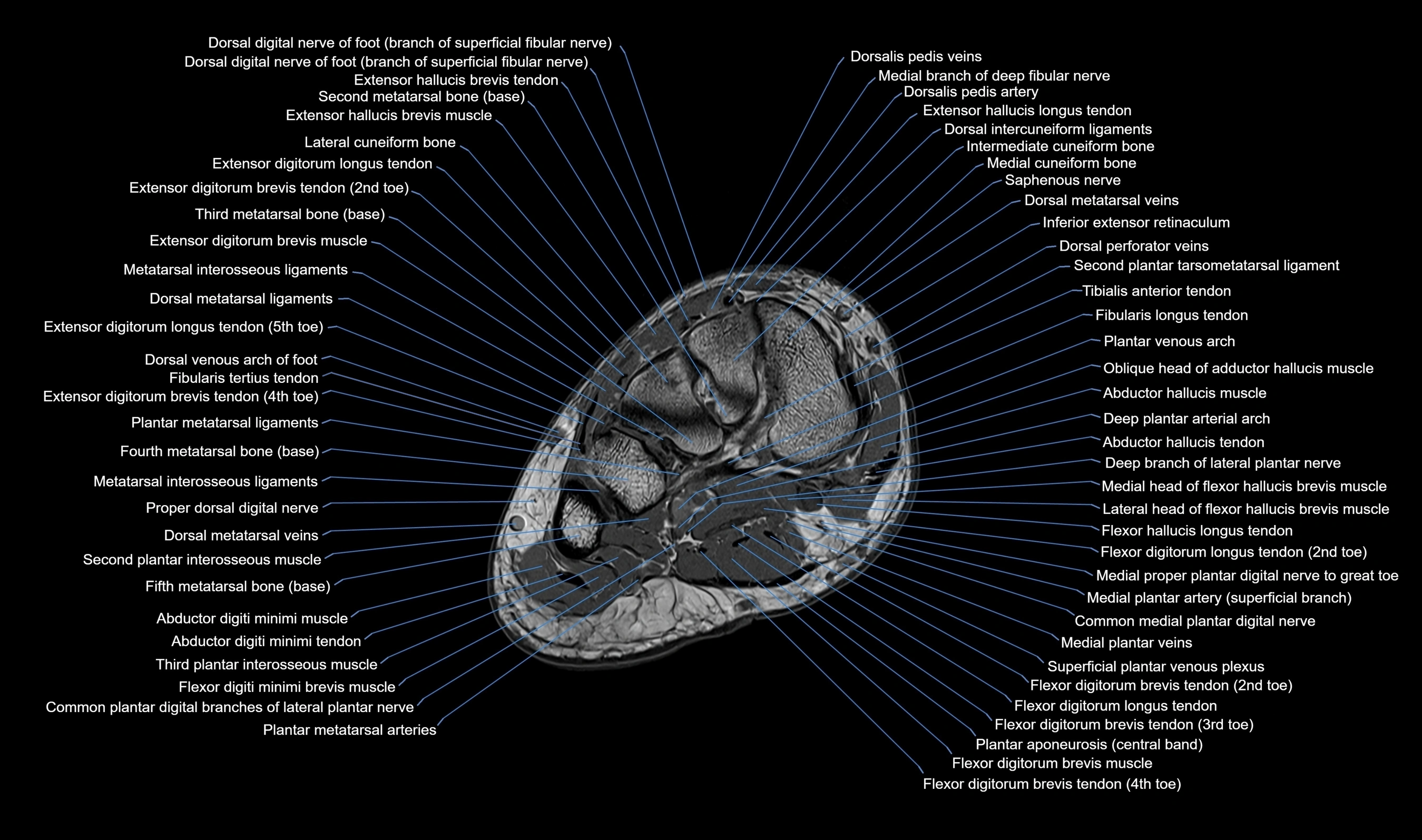 MRI mid foot axial cross sectional anatomy 3T  radiology  image-img-00001-00017.webp